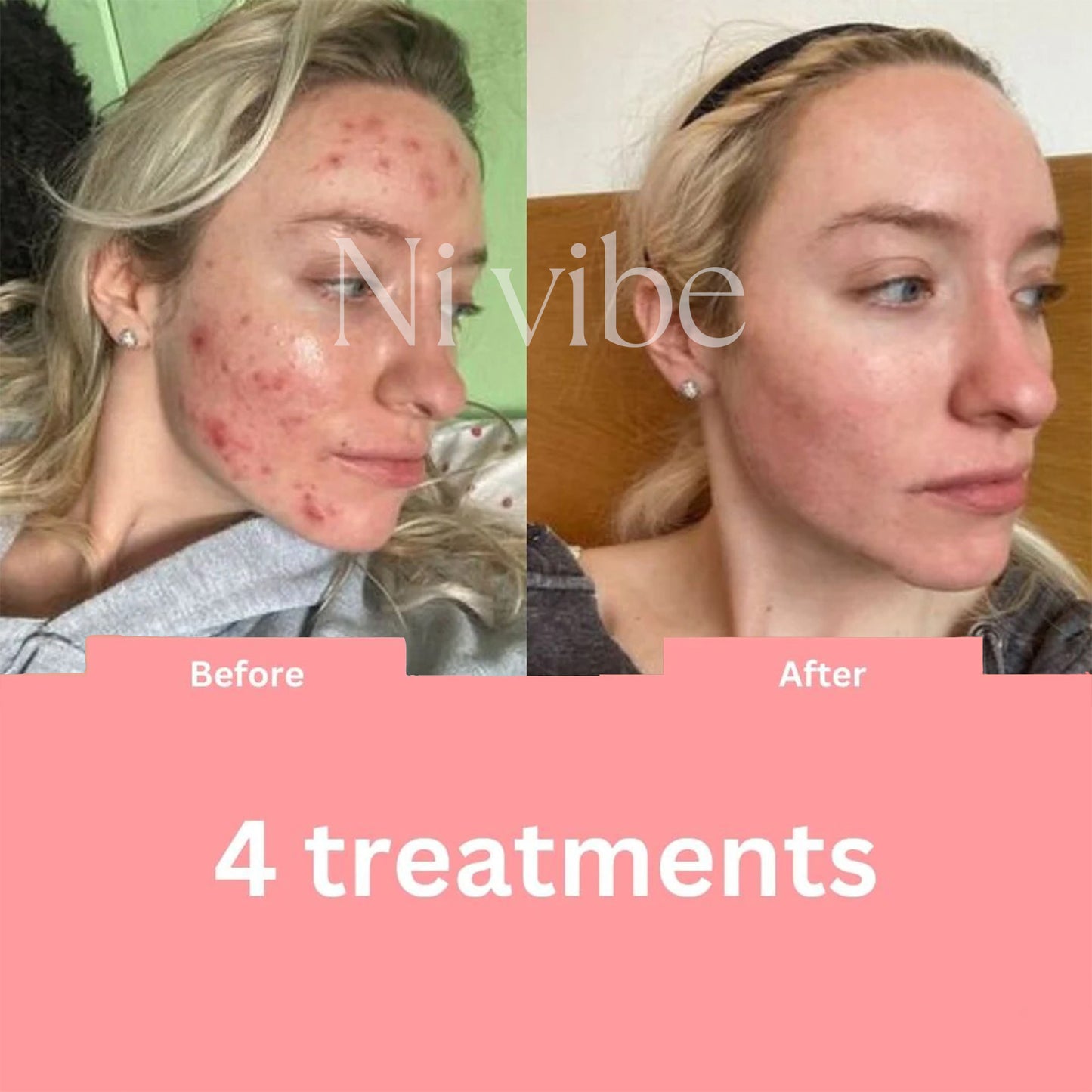BeautyPro 2.0 - High Frequency Wand